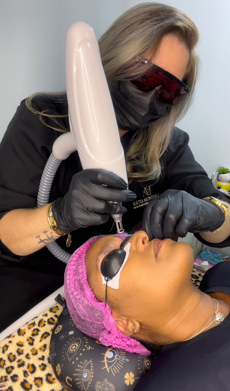 Remoção de micropigmentação a laser