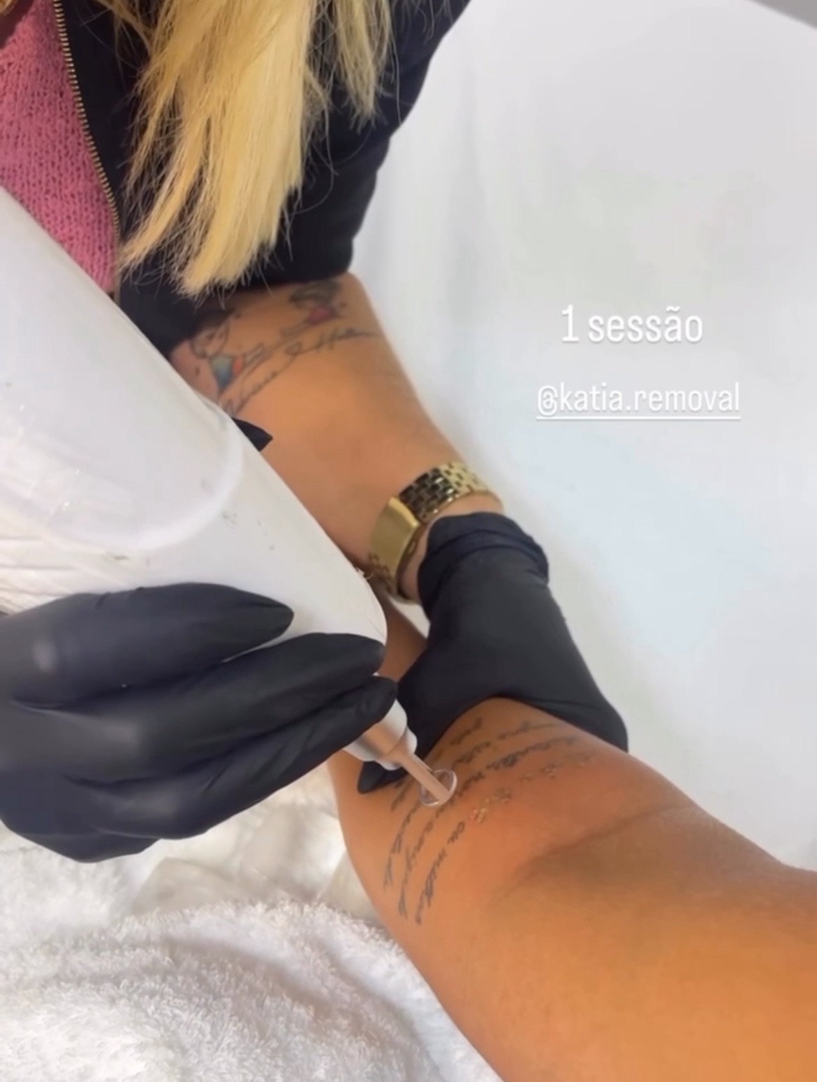 Remoção de tatuagem a laser
